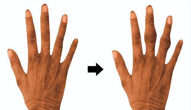 疾病|身体有疾,手脚会有表现?4种表现,需及时排查原因