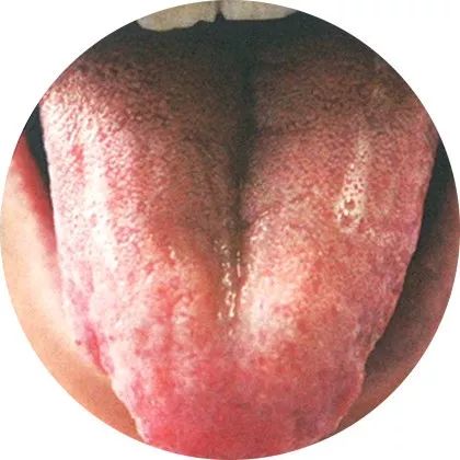 失眠|中医中的舌诊,了解吗