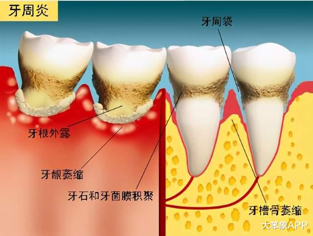润肺止咳|牙齿脱落的“头号杀手”——牙周病，它的成因你了解吗？