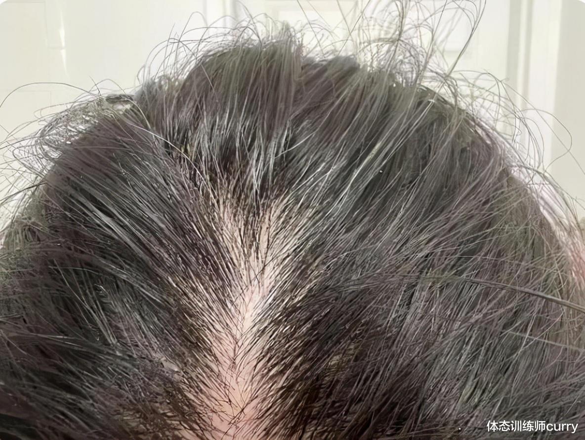 白发|女性“白发”日渐增多，不要以为自己老了，可能是缺乏3种营养