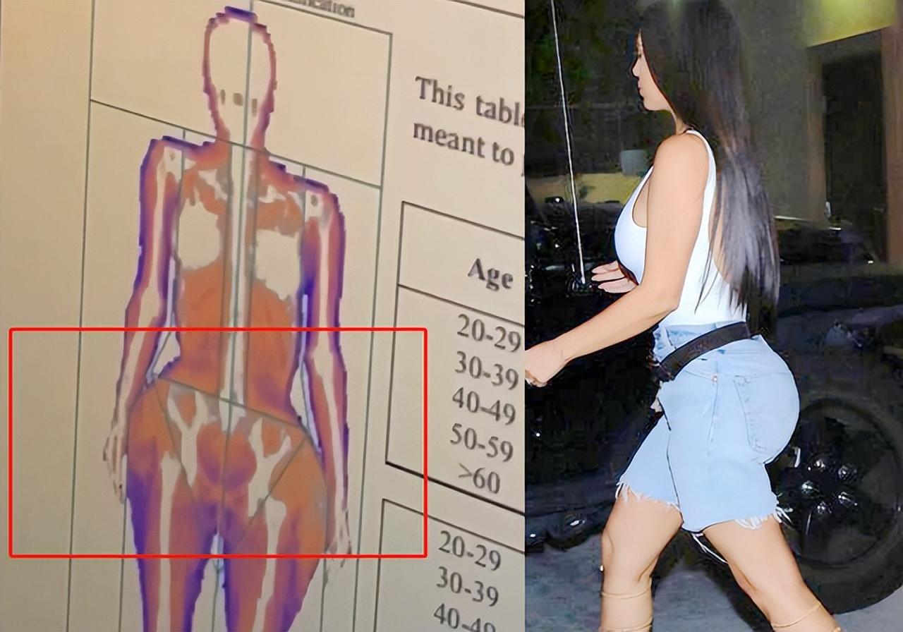 文咏珊|卡戴珊正式离婚，穿运动服现身，骨盆畸形暴露！