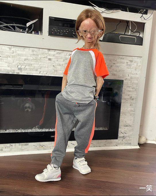 早衰症|知名网红阿达莉亚·罗斯因早衰症去世，年仅15岁，家人公布死讯