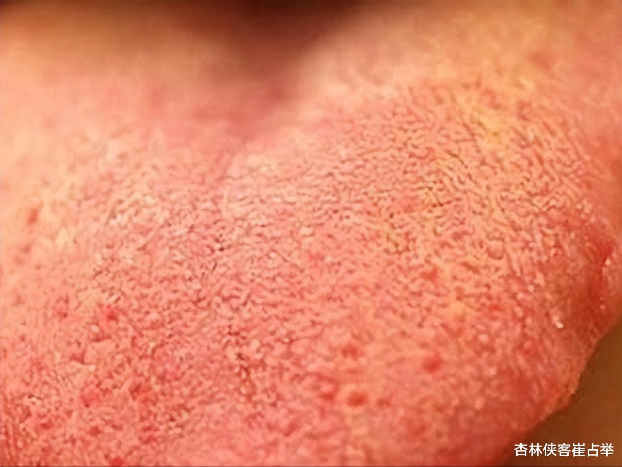 过敏反应|心火、胃火、肝火、肺火、肾火,身体会出现哪些改变?该怎样降火