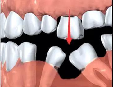 牙齿|牙齿缺失，长久后会变成怎样？