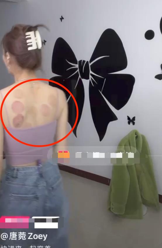 曹云金|曹云金前妻直播秀身材！穿吊带后背全是火罐印，红肿一片湿气重