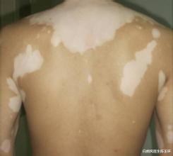 白癜风|开学季,学生白癜风患者要注意哪些护理问题?