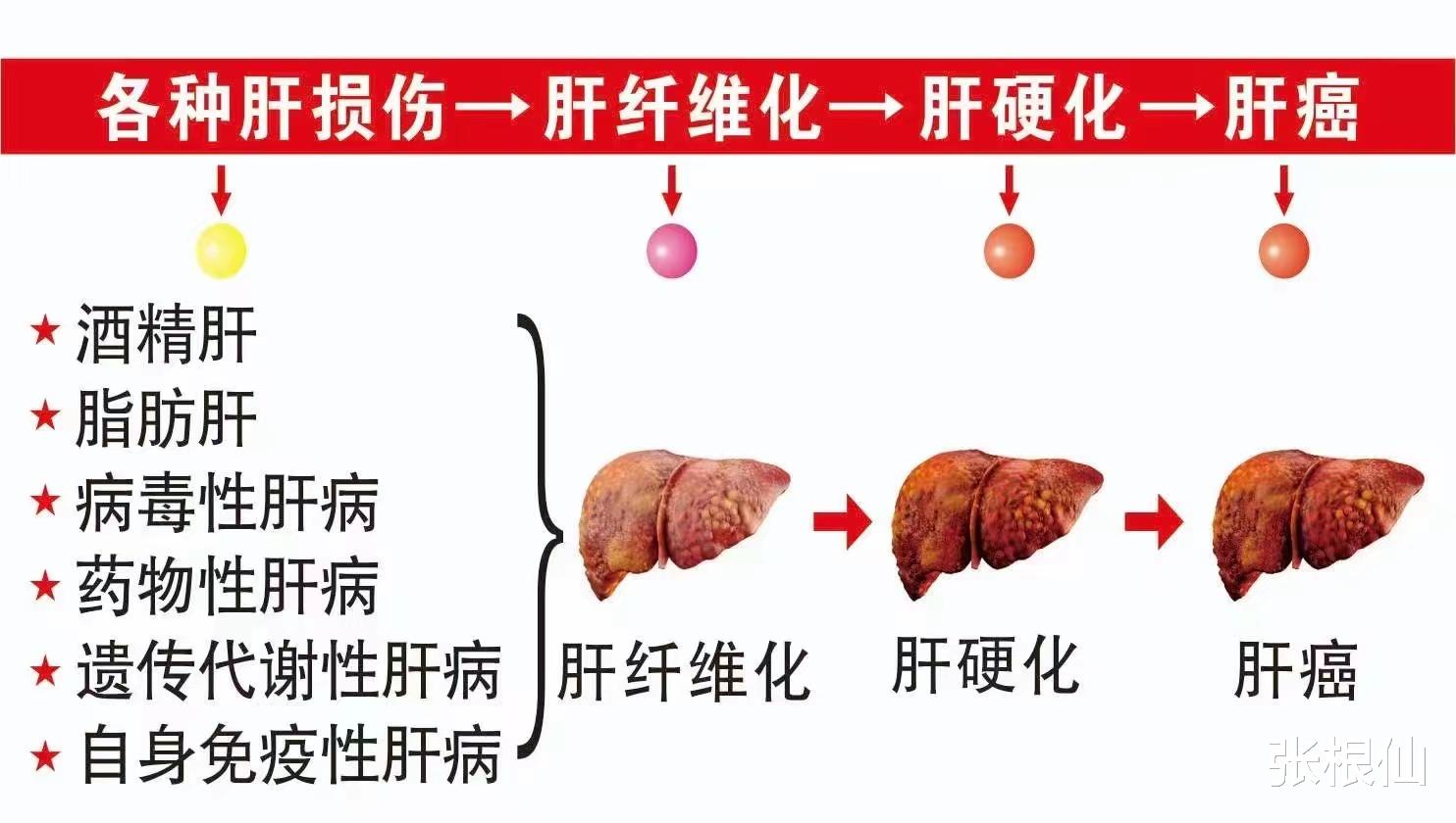 肝脏|张根仙：肝脏不好的14个自测方法，请你仔细对号入座！
