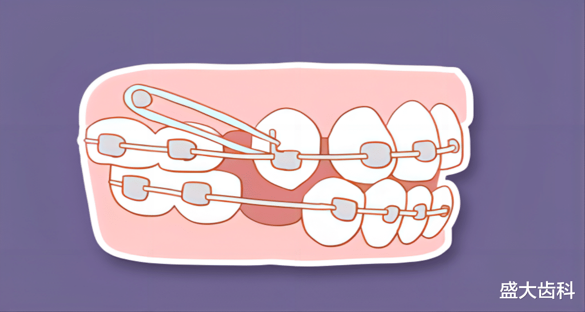 牙齿|支抗钉要带多久？