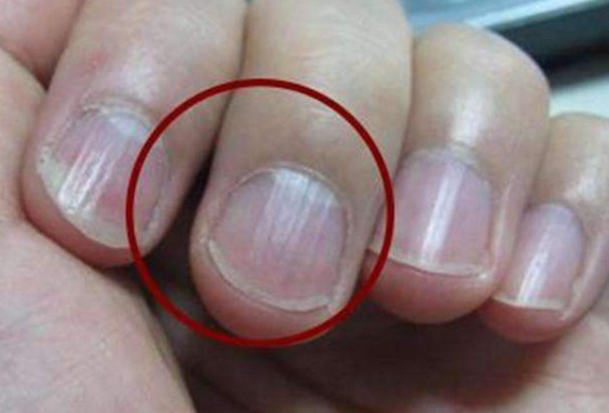贫血|手指甲出现竖纹是怎么回事?或许是身体发出的信号,自测一下吧