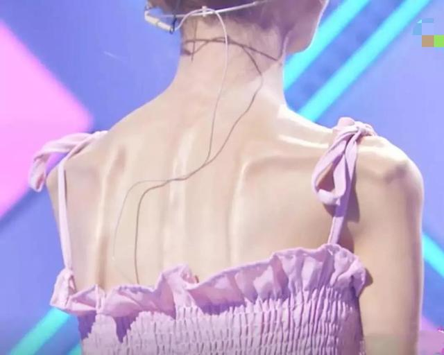 祛斑 从120到58,行走的“骷髅妹”为爱瘦身:那些被减肥毁掉的女孩们。