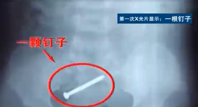 陕西1岁女婴住院期间,体内连续冒出19枚铁钉,医生无奈选择报警!