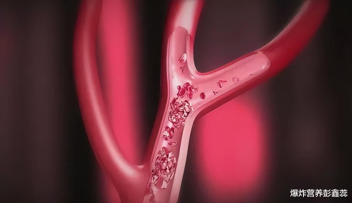 心力衰竭|每天都运动的人,就不会得心梗、脑梗、中风吗?看看最新研究