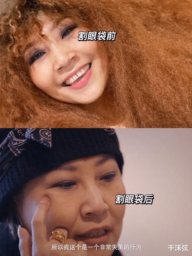 整容|55岁张蔷自曝整容失败！素颜怼脸大方展示疤痕，吐槽医生不认真