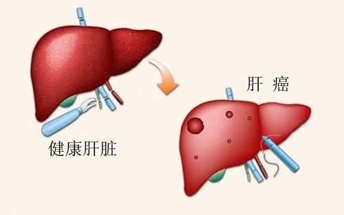 鹌鹑蛋|肝癌找上门！身体出现这些表现，中医治疗肝癌方法介绍。