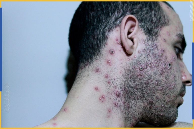 甲状腺疾病|猴痘不像新冠病毒 这就是原因