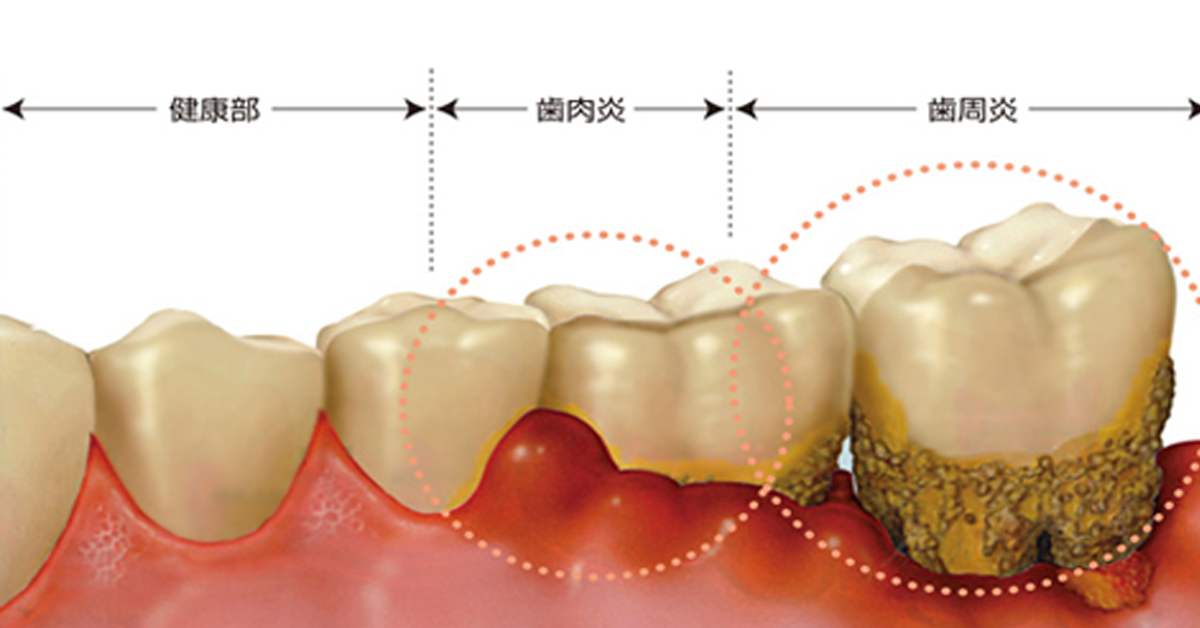 牙齿|科普：健康需要一口好的牙齿，吃嘛嘛香