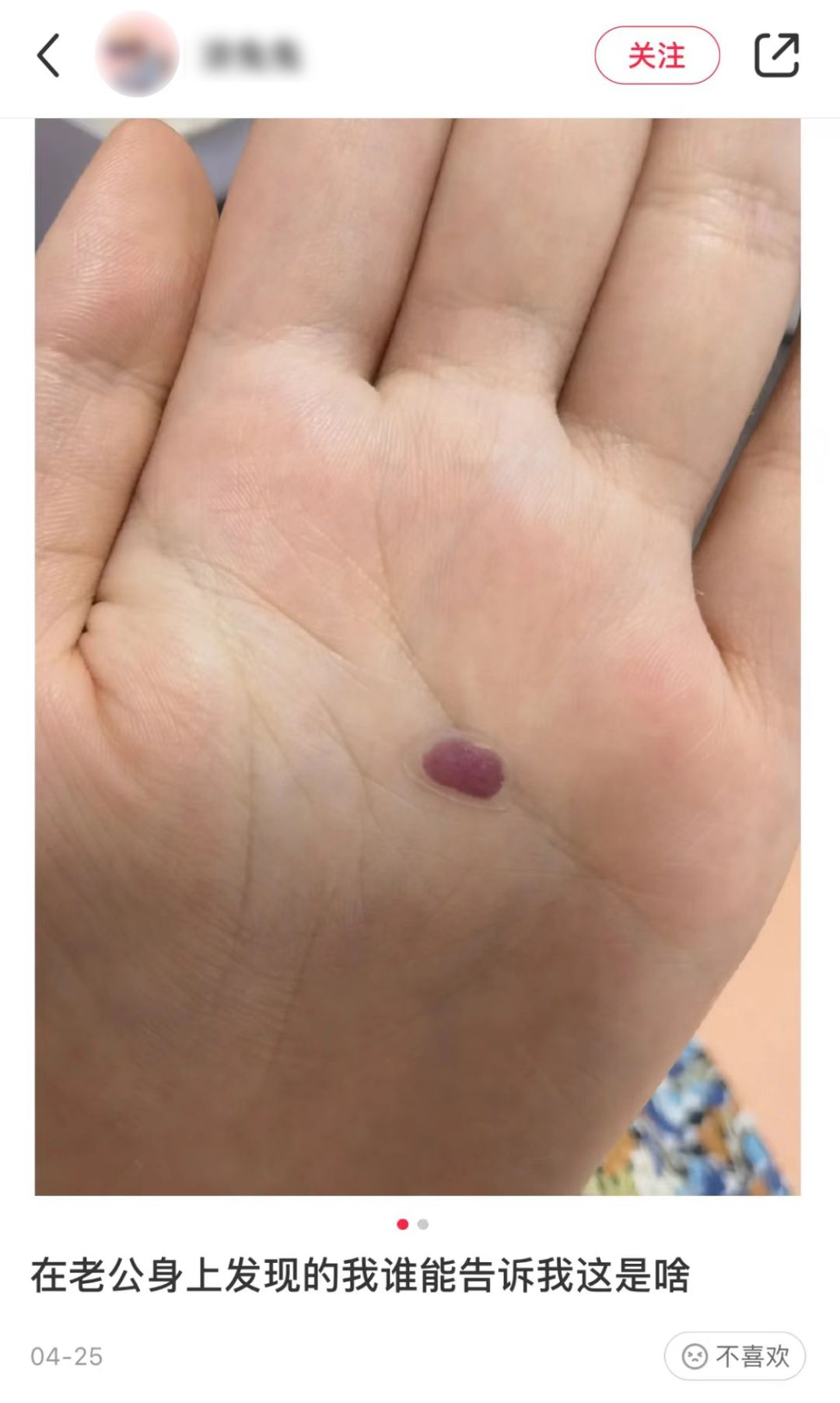 网友在老公身上发现不明物体，在线求助后，得到的答案五花八门