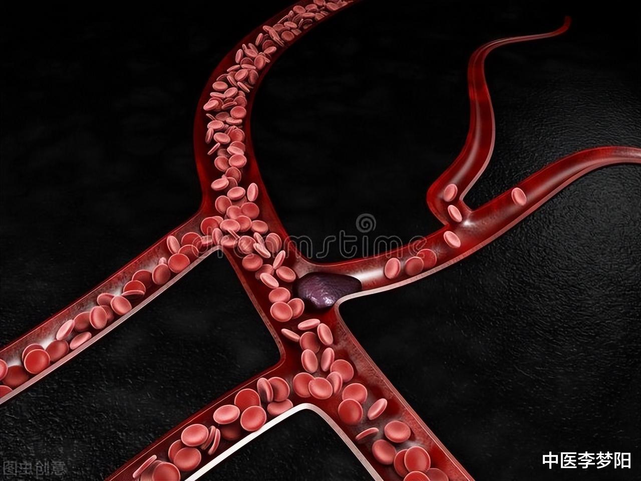 运动|世间无怪病,只是堵和瘀,分享一个活血方,通血、通脉、通全身