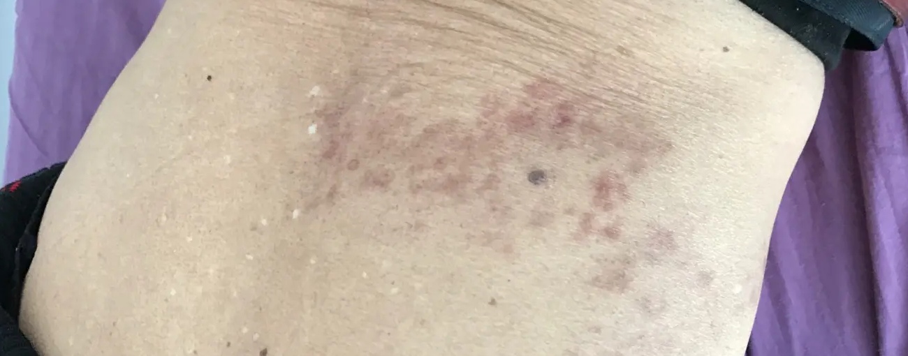 脊康杏林 带状疱疹可以针灸治疗吗？