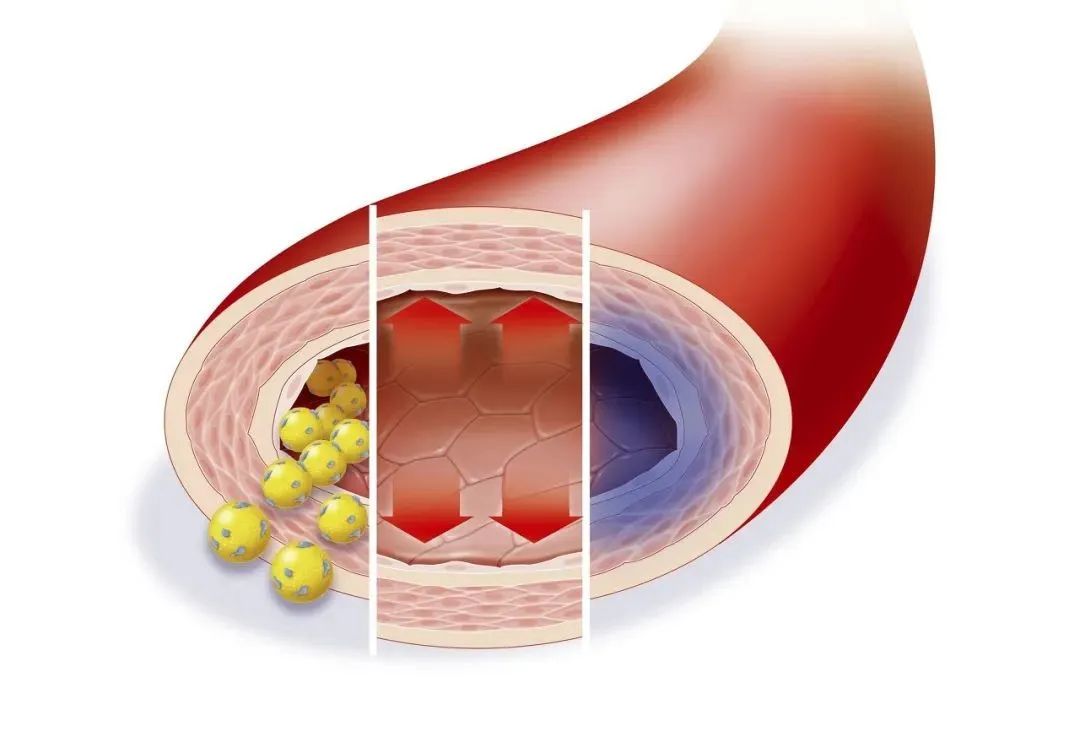 饮食|出现这些症状别轻心，很有可能是动脉硬化找上门了！