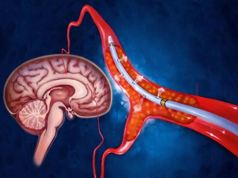 脑梗|为啥中国脑梗患者越来越多？医生：与肥肉无关，三种调料请少用