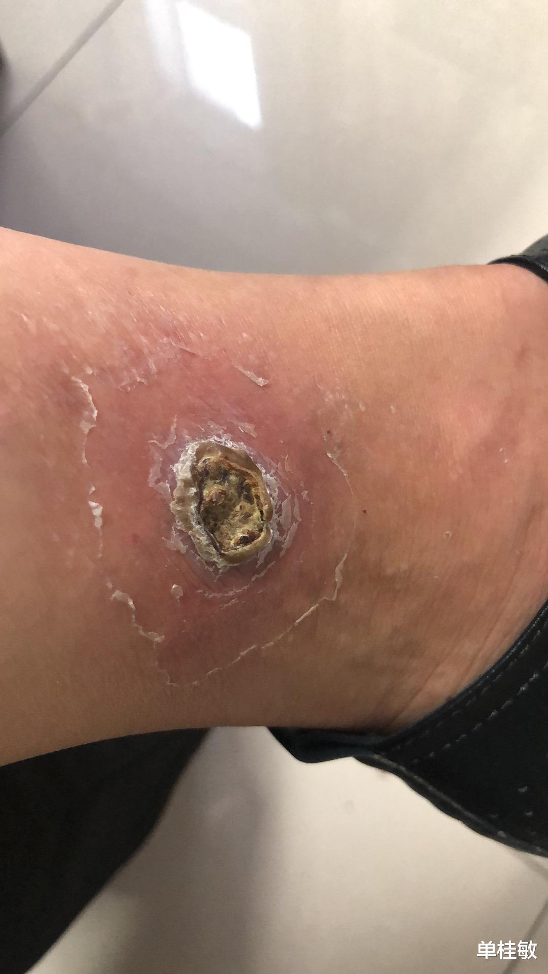 椰子|关于灸疮如何处理