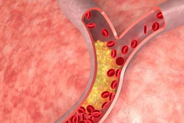 穴位|高血脂指标参考值 | 高血脂多少范围算是正常？