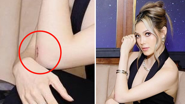 谷爱凌|谷爱凌晒近照令人心疼！手肘伤口疤痕明显，训练时摔得至今未好