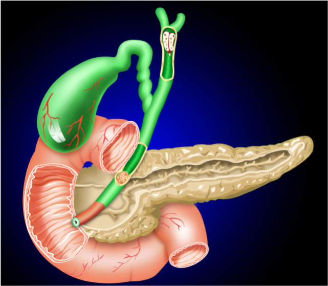 降压药|中医院士张伯礼，为何用手术切除胆囊，而不用中药？看下理性分析