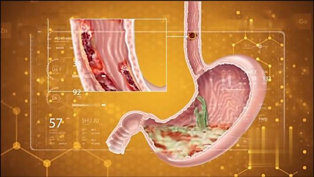 胃癌|看不懂胃部检查单？一旦出现这4个字，再不治疗可能就晚了！