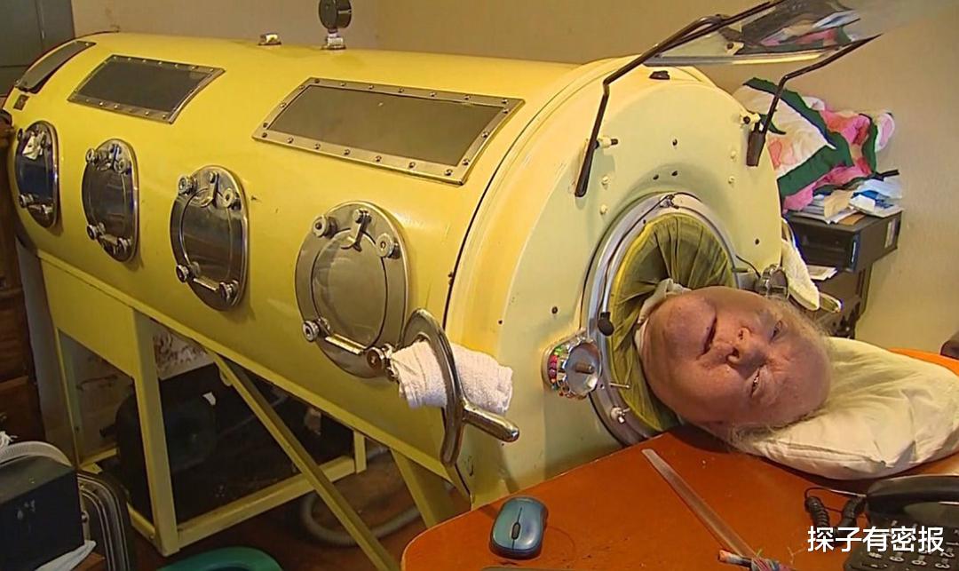 感冒|肺人被困在“铁桶”70年,无法自主呼吸,停电就意味着死亡