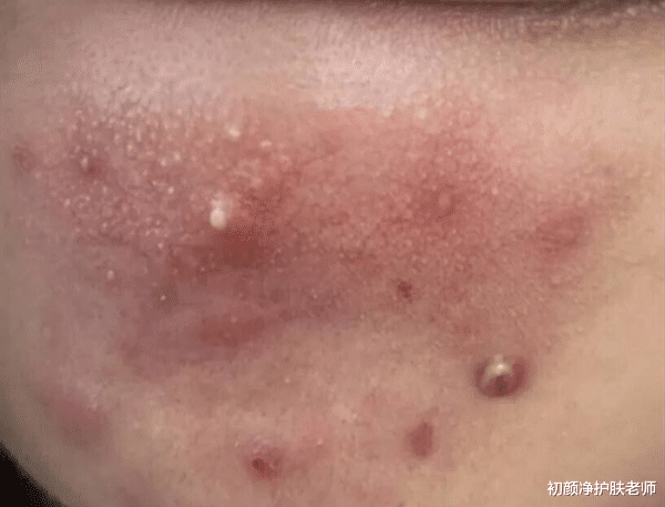 痤疮 痘痘并不代表青春,关于痘痘的那些事!