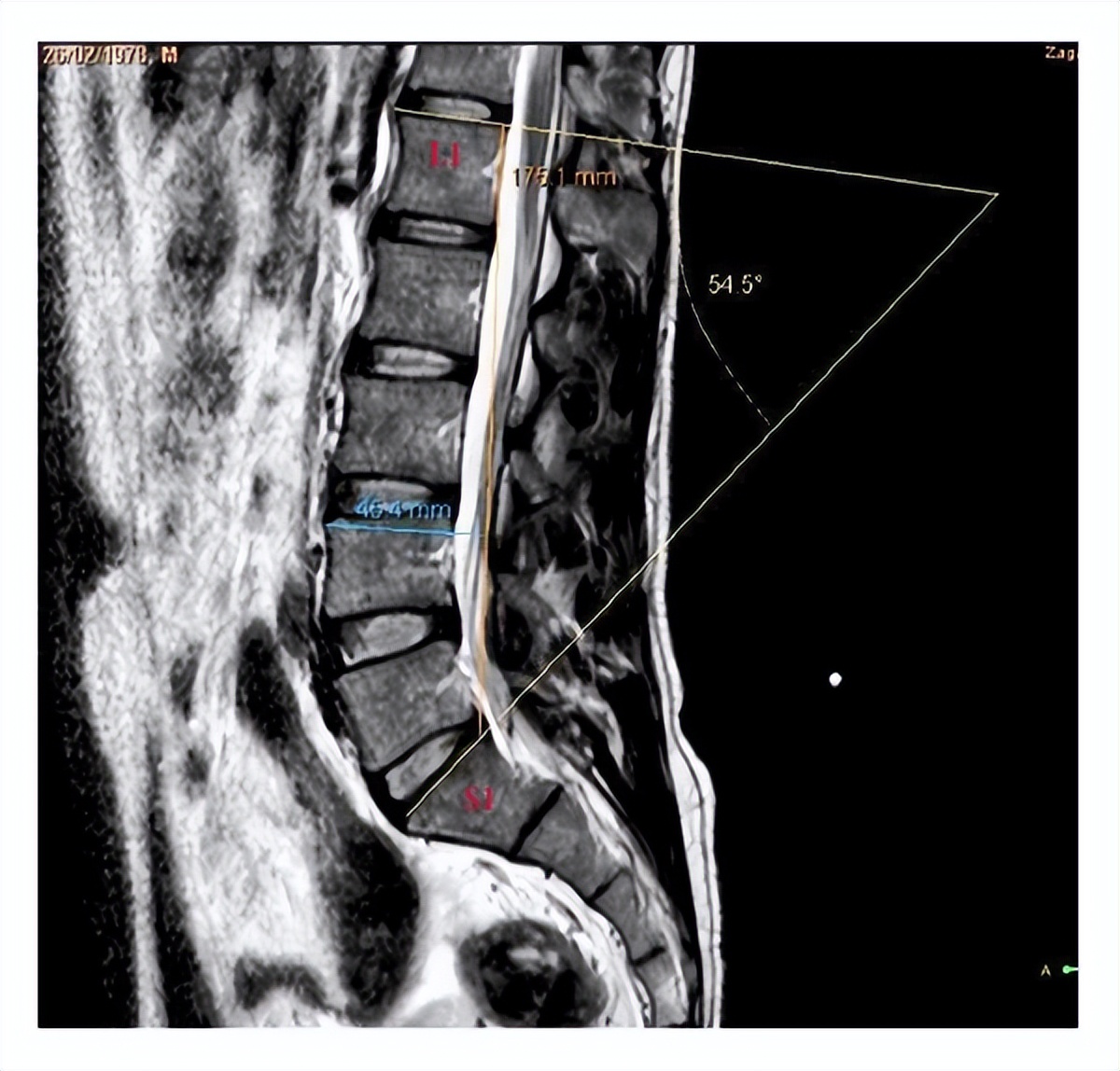 核磁共振|身体里有“内固定”，绝对不能做磁共振？医生辟谣，给您靠谱答案