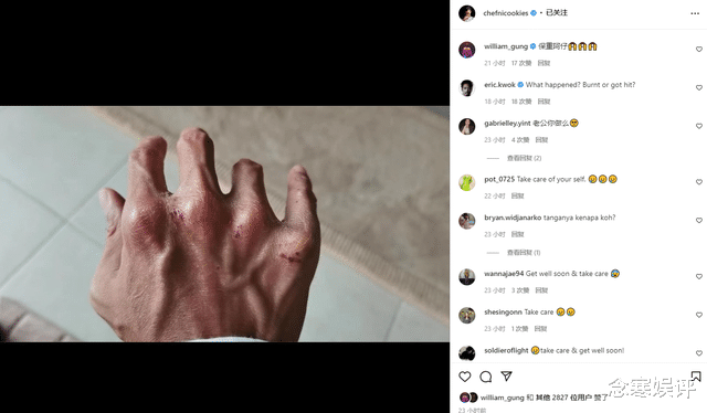 谢霆锋|谢霆锋深夜晒出右手受伤照，手背满是伤痕疮疤，红肿破裂不忍直视