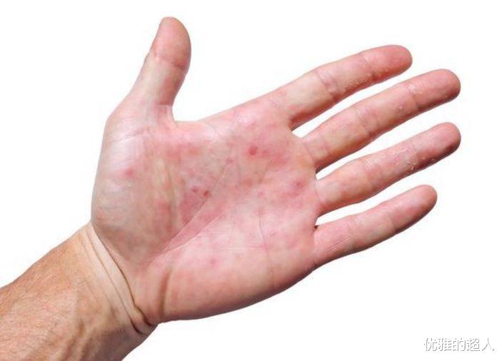 腰椎间盘突出|皮肤出现这8种变化，可能是癌症发出的信号！