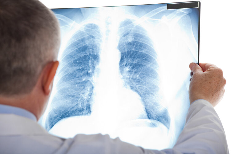 肺癌|肺癌来临总是“不声不响”！忠告：身体有这4个表现，尽早检查