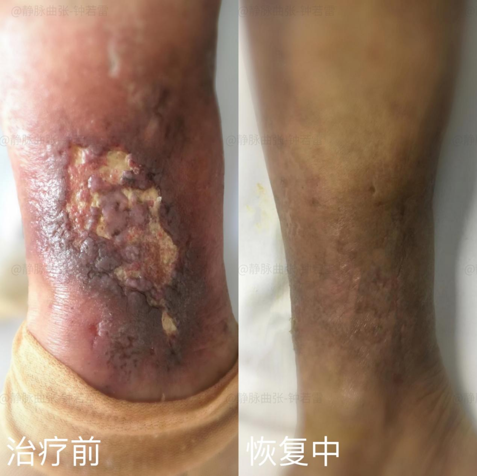 |患者问答|老烂腿是绝症吗