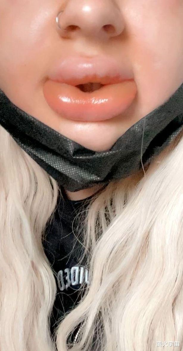 香肠 英国24岁女子第一次丰唇肿成“香肠嘴”,填充物膨胀到原来的20倍