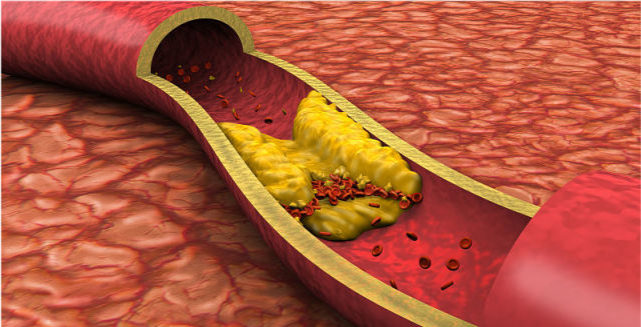 睡眠|血管堵塞的罪魁祸首公布了,并非大鱼大肉,望你早做了解,尽早避免