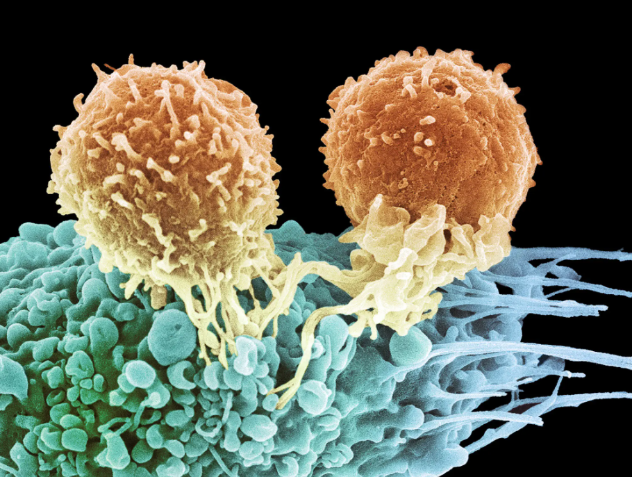 肾结石|癌症将死之人，每天喝“它”杀死大量癌细胞成功抗癌