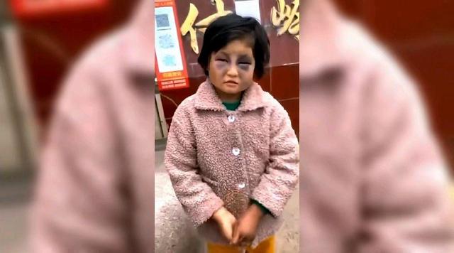 小女孩被打得面目全非,双眼淤青,竟是因为偷钱被母亲殴打所致