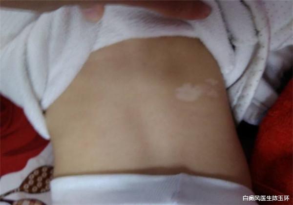 肝脏|白癜风饮食需要注意的三大事宜