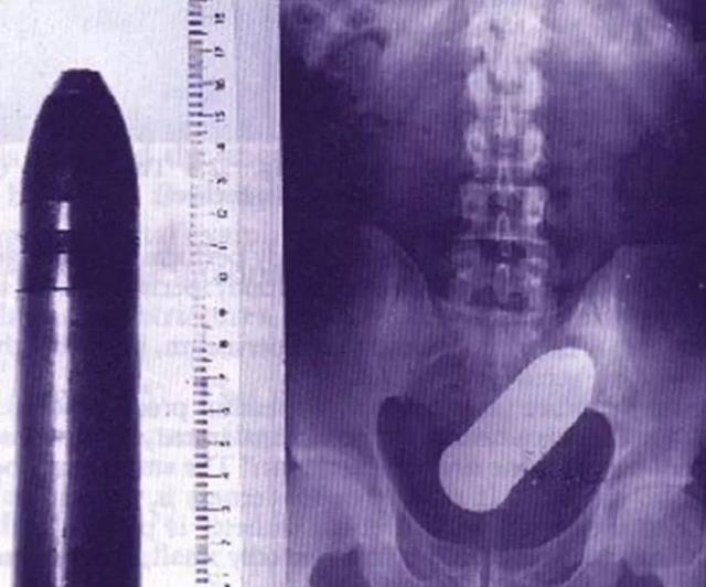 肺癌|盘点30张奇奇怪怪的X光片，看完整个人都不好了！