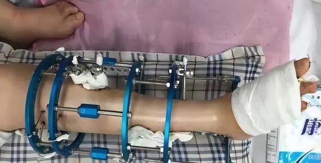 迪士尼|曾花16万断骨,只为长高7.2厘米的李亚诺,如今与后遗症为伴