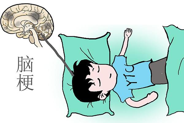 针灸|60%的脑梗和它有关,提醒:身体若发出4个异常信号,可别大意了