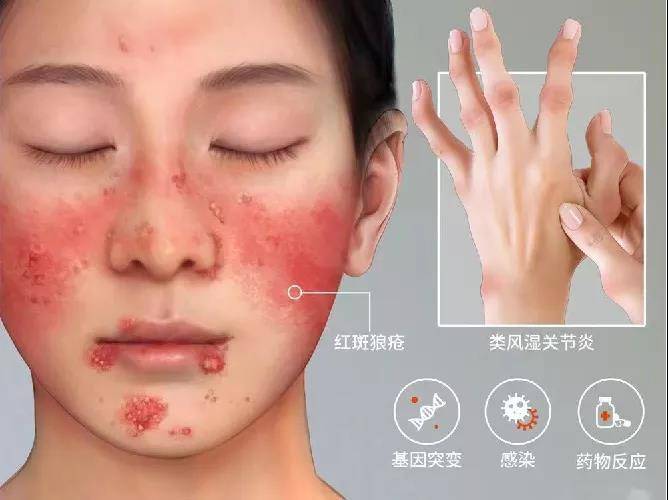 中科西部干细胞研究院:干细胞在自身免疫性疾病中的临床研究