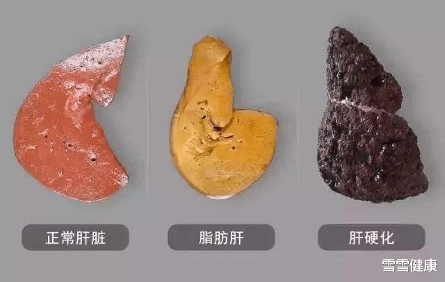 熬夜|大补之物变“大毒之物”,常年一杯枸杞水,差点引发肝癌