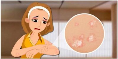 美颜|牛皮癣在生活上有什么需要注意什么,牛皮癣患者初期应了解哪些常识呢
