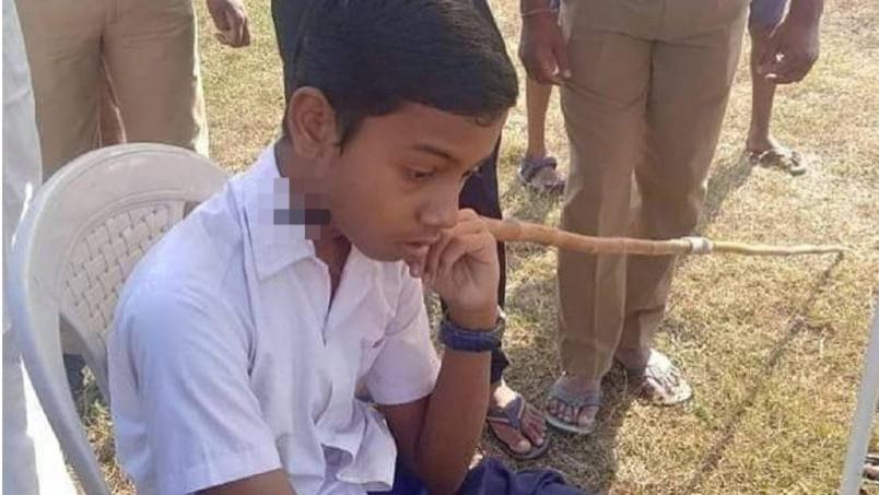 超命大！印度14岁少年遭「标枪刺穿脖子」，淡定坐等救护车送医