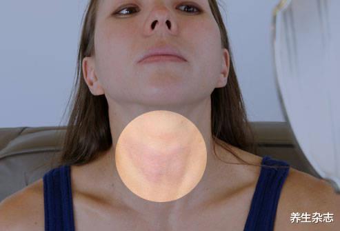 甲状腺癌|身上这里长出“肉疙瘩”,或是甲状腺癌前兆?30岁以上尤其注意
